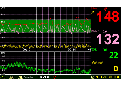 Respbuy_LuckCome_CTG3 LuckCome Fetal Monitor (CTG) - Dual FHR | Two Year Warranty